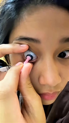 Removing a Stuck Contact Lens Safely