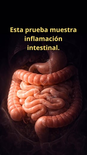 Carla M. | Intestino Sano | La calprotectina fecal es un marcador de inflamación intestinal. Valores por debajo de 50 mcg/g generalmente indican ausencia de... | Instagram