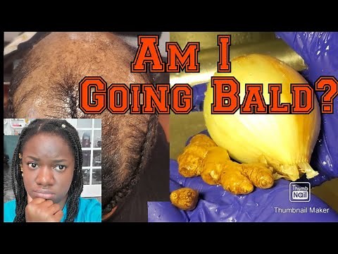 Powerful Ginger, Onion and black Jamaican castor oil Hair growth recipes for hair loss.