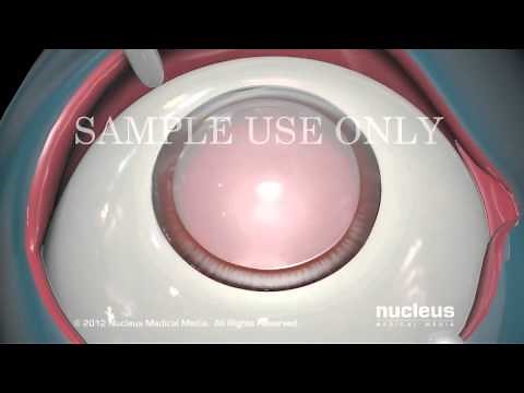 Cirugía de cataratas: Extracción de cristalino e inserción de prótesis de cristalino