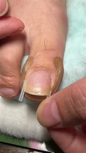 Nail correction #Is there any guy who has toenails for piercing flesh? #What should I do if my ..