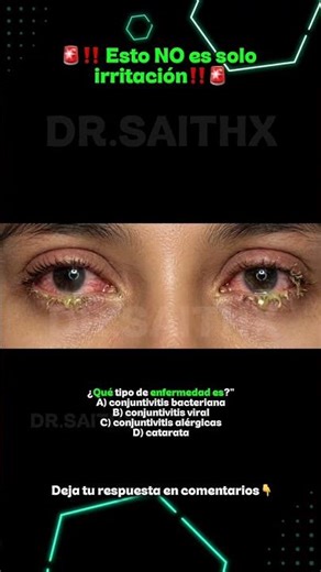 Conjuntivitis bacteriana