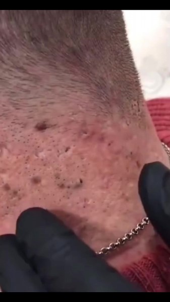 Effective Pimple Removal Techniques Explained