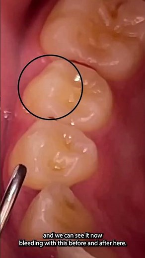 Charting bleeding on probing #hygienist