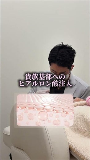 【鼻横の凹み、自然に整えるヒアルロン酸注入💎】 #福岡美容クリニック #美容 #福岡美容皮膚科
