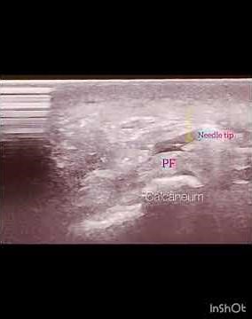 USG guided plantar fascitis injection