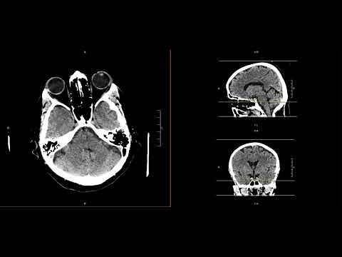 Intracranial Contents Part 4 (Brain Parenchyma)