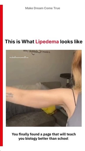 💪 This is What Lipedema 🦵 Looks Like 🧑🏻‍⚕️ | MDCT