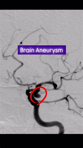 Vatsal Kania on Instagram: "A sudden worst-ever headache brought this 65-year-old lady to the hospital. Scans revealed the culprit: a ruptured brain aneurysm—a weak spot in a blood vessel that decided to misbehave(bleed). Instead of open surgery, we fixed it from the inside. With the help of a temporary balloon, soft coils were placed to seal the aneurysm and stop the bleeding—while keeping normal blood flow safe and without opening the brain. Small tools. Big impact. Saving one brain at a time.