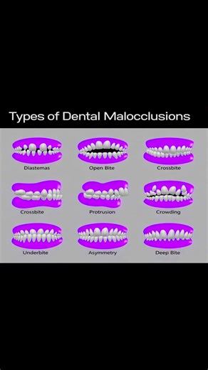Different types of dental malocclusion!