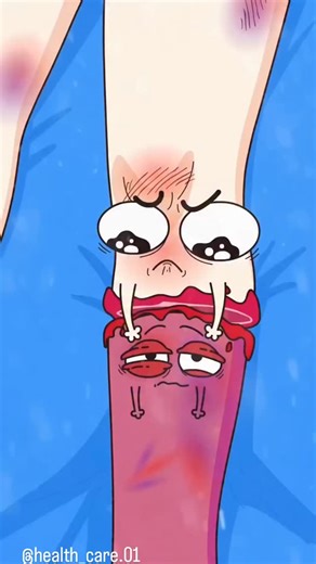 editor...😎🦅 on Instagram: "Phantom Limb Pain—or something else? | After amputation, the brain and nerves can misfire, creating real pain in the missing part (phantom limb pain), often burning, stabbing, cramping, or “pins & needles.” It’s distinct from residual limb pain (skin, neuroma, prosthesis fit) and from CRPS or radiculopathy. Drivers include neuroma hyper‑excitability, spinal “central sensitization,” and cortical remapping; stress, poor sleep, and stump pressure can flare it. Red flags