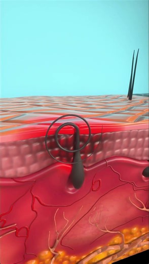 What Happens When Hair Grows Inside Your Skin? (Ingrown Hair Explained)