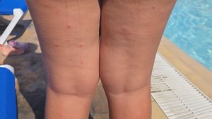 Family's Cuban vacation turns to bed-bug ridden nightmare