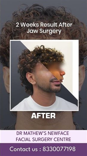 2 Weeks After Jaw Surgery 👑 Before & After Transformation | Dr Mathew PC