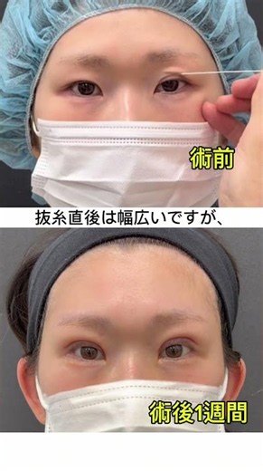 全切開ならシモキタスキンにお任せください。