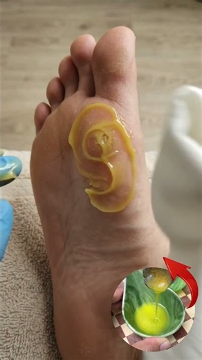 Foot Corn Making Every Step Uncomfortable! Give Your Feet Some Extra Care! 🦶✨ #FootCorn #FootCare
