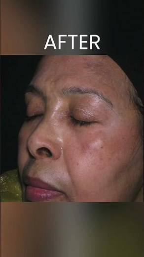 Melasma Treatment Before and After Transformation #cosmeticdermatology #skincare