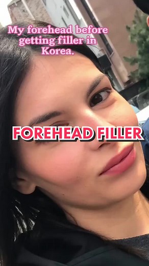 Korean Forehead Filler Techniques Revealed