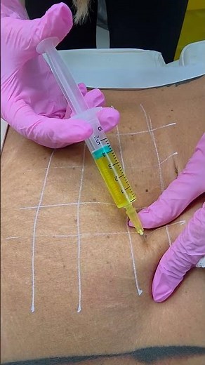 💛 Learn Lemon Bottle Fat Dissolving Injections – Accredited Training £300 💛 #LemonBottle