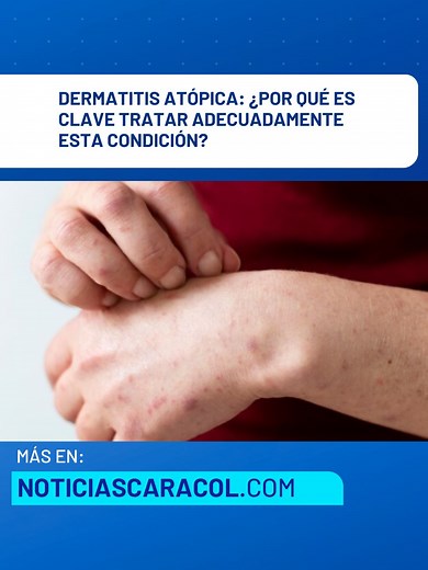 Este mes se celebra el Día de la Dermatitis Atópica, una condición que si no se trata adecuadamente puede afectar la calidad de vida. Le contamos. Más en noticiascaracol.com #Salud #Dermatitis #NoticiasCaracol