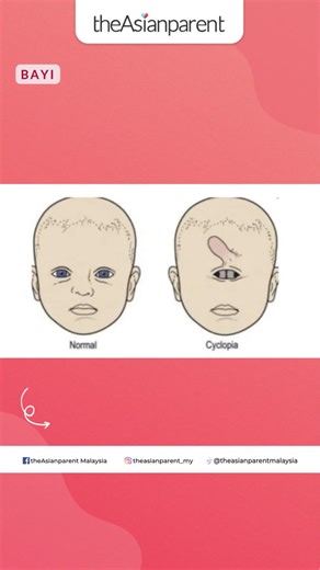 Cyclopia: Memahami Keadaan Bayi dengan Satu Mata