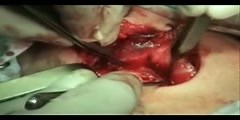 Total Thyroidectomy Surgery Operation Video