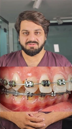Have a Crossbite? Here is Exactly How We Fix It ​#Crossbite #Orthodontics #DentalCare #Braces