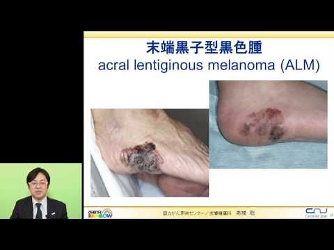 No.2 About malignant melanoma (melanoma) Satoshi Takahashi