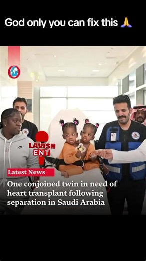 one conjoined twin in need of heart transplant after separation #jamaicantiktok🇯🇲viral #news #jamaicantiktok
