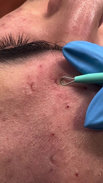 🎥 Let’s Talk Whiteheads! 🎥 Ever wondered how those little white bumps appear on your skin? 🤔 What causes whiteheads? Whiteheads form when your pores get clogged with oil, dead skin cells, and sometimes bacteria. Unlike blackheads, the clog stays closed under your skin, creating that white bump. How to prevent them: ✨ Cleanse regularly: Use a gentle cleanser to keep your skin clean without over-drying. ✨ Exfoliate weekly: Remove dead skin cells to avoid clogged pores, but don’t overdo it! ✨ Mo