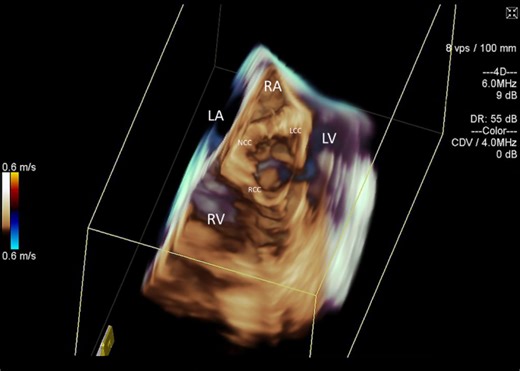 Implantation of Impella CP left ventricular assist device under the guidance of three-dimensional intracardiac echocardiography - Scientific Reports