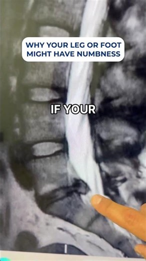 Foot numbness explained: what disc extrusion means for nerves and recovery 🦶 #healthtips