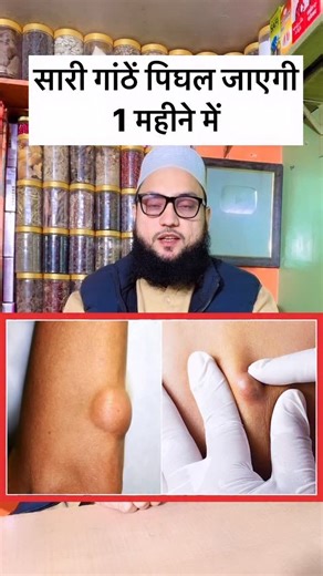 Maulana Farman Nasim on Instagram: "हर तरह की गाँठ सही हो जाएगी…🙂 . . . . . . #health #healthy #ayurwedalife #shorts #trending #explorar #exploremore #maulanafarmannasim9222"