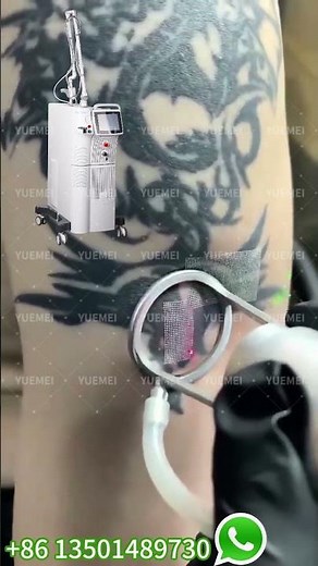 Two-Step Tattoo Removal: CO2 Laser & PicoSecond Laser Explained