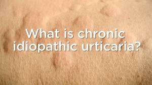 What is chronic idiopathic urticaria? Living with itchy hives