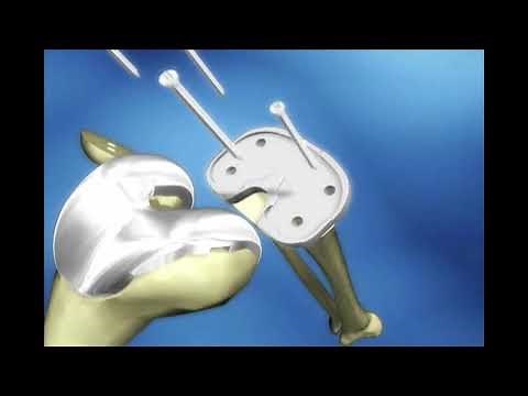 Dr. Richard Berger - Minimally Invasive Knee Replacement Surgery