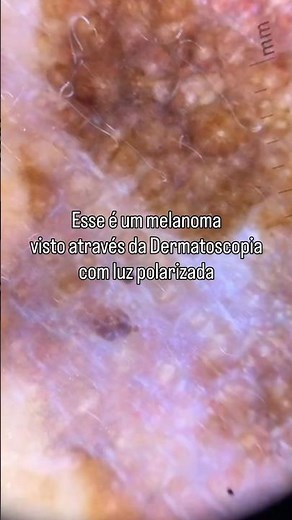 O melanoma visto na Dermatoscopia. #melanoma #dermatoscopia