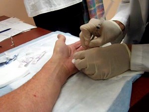 Dupuytren's Contracture - 8 minute Cure