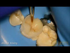 Direct cuspal coverage (overlay) after endodontic treatment