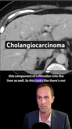 Abdominal CT Tutorials - Cholangiocarcinoma (Klastkin)