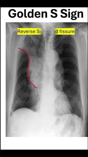 60 Seconds Chest X Ray Signs: That Win MCQs