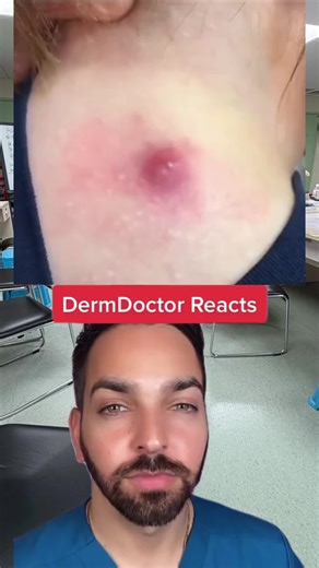#dermdoctor #dermatologist #cyst #pimplepopper #learnontiktok | pimple popper