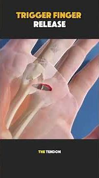 How Trigger Finger Release Surgery Is Done | Step-by-Step Explanation #medicaleducation