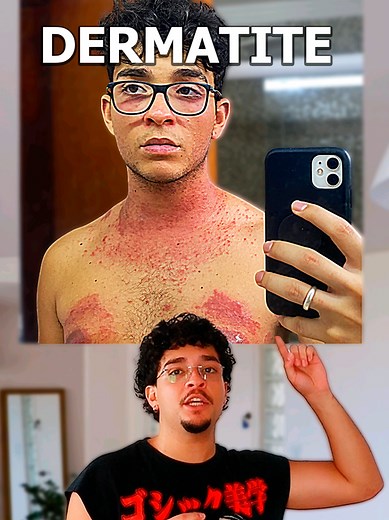 Dermatite Atópica: Emoções e Alergias