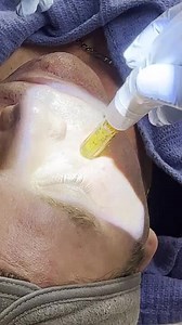 Microneedling with Platelet Rich Fibrin (PRF)  the next generation of PRP