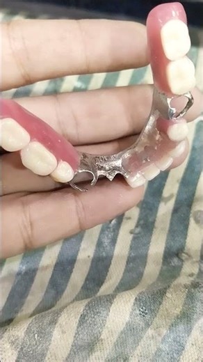 Lower Removable Cost Partial Denture Come For Teeth Addition 😁😁😁#rpddentalprocedure