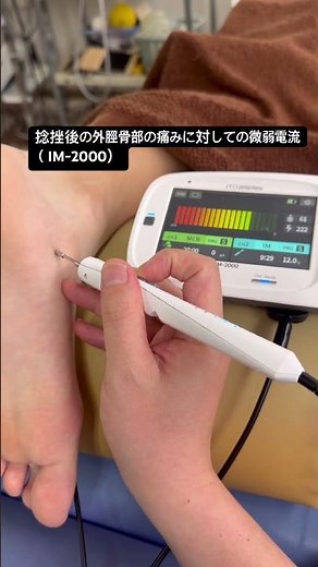 足首の捻挫後の外脛骨部の痛みに対しての微弱電流（IM-2000） #外脛骨障害