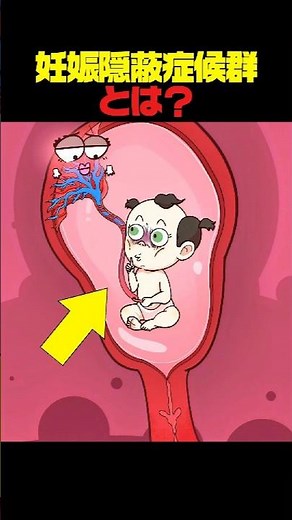 妊娠隠蔽症候群とは？