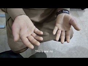 Palmoplantar keratoderma (Teaching on Patient)