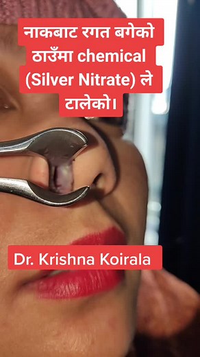 Epistaxis Treatment with Silver Nitrate Cautery | Shree Krishna ENT Care